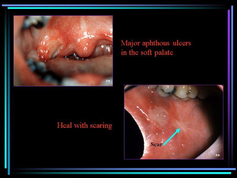 Heal with scaring Major aphthous ulcers in the soft palate Scar